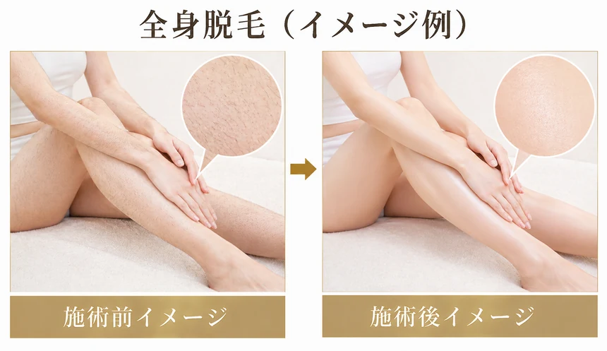 全身脱毛 お試し1回 19,800円｜渋谷美容外科クリニック