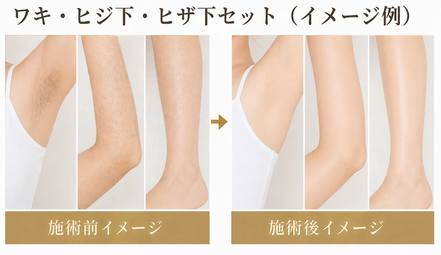 ワキ・ヒジ下・ヒザ下 セット脱毛 お試し1回 9,800円｜渋谷美容外科クリニック