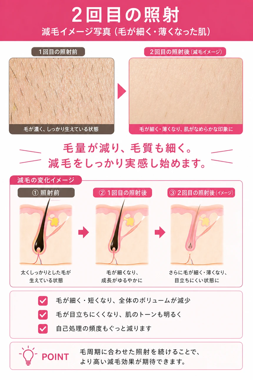 医療脱毛 2回目の照射（毛量約60%）