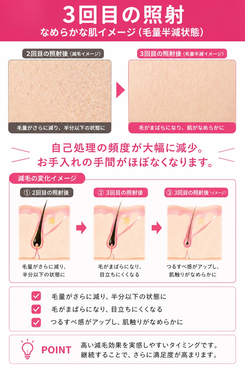 医療脱毛 3回目の照射（毛量約30%）