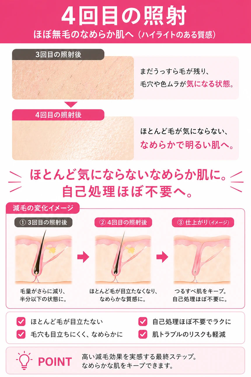 医療脱毛 4回目の照射（毛量約10%）