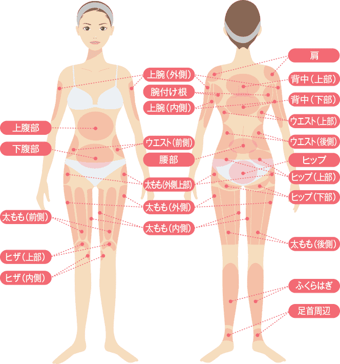 脂肪吸引施術部分のイメージ図