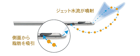 ジェット水流噴射、側面から脂肪を吸引