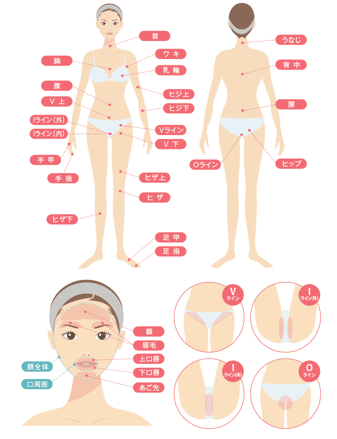 医療レーザー脱毛の施術可能な部位のイメージ図