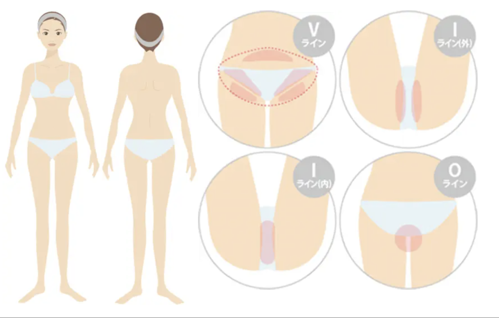 医療脱毛の施術部位のイメージ図