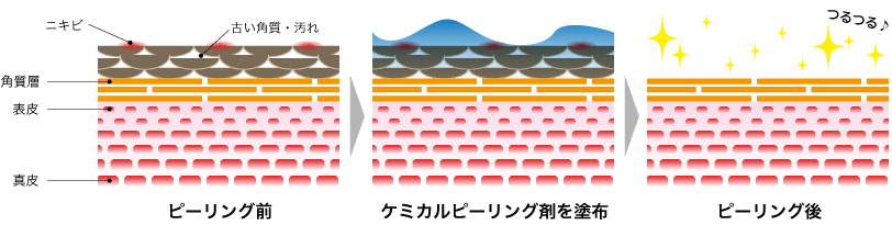 ケミカルピーリング治療の図解