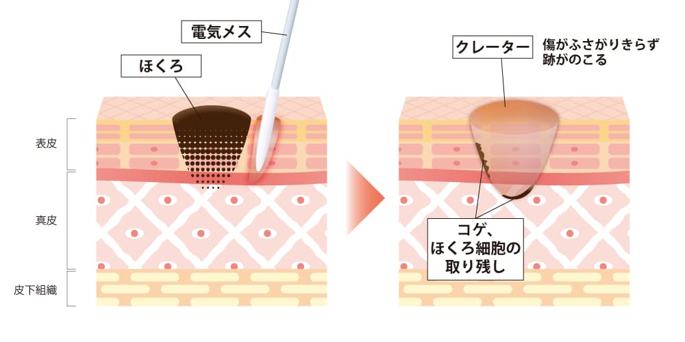 ホクロ取り焼灼法イメージ図