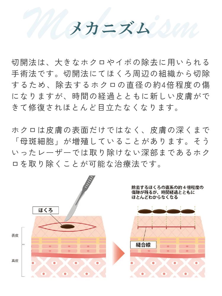 切開法 メカニズム