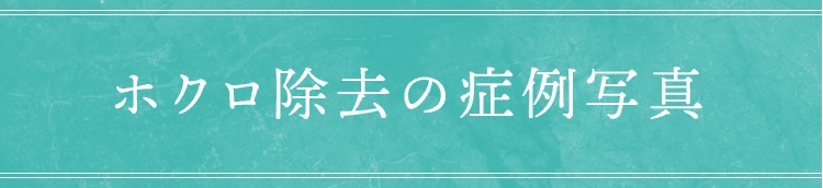 ホクロ除去の症例写真