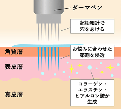 ダーマペン使用図解