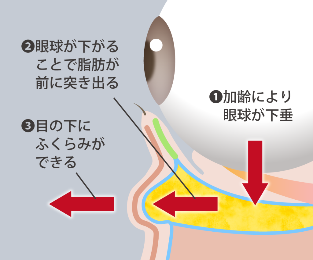 眼の下に膨らみがある目元がある図解