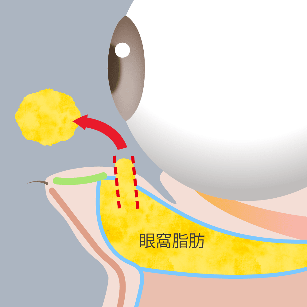 下眼瞼脱脂の図解