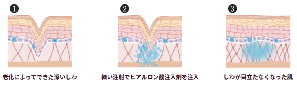 ヒアルロン酸注入による美容効果のメカニズム図解