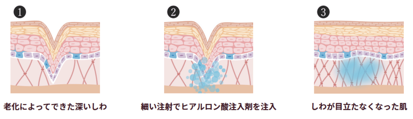 ヒアルロン酸注入による美容効果のメカニズム図解