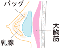 乳房下法の図解