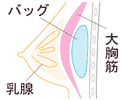 大胸筋下法の図解