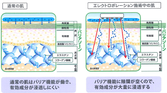 エレクトロポレーション施術の図解