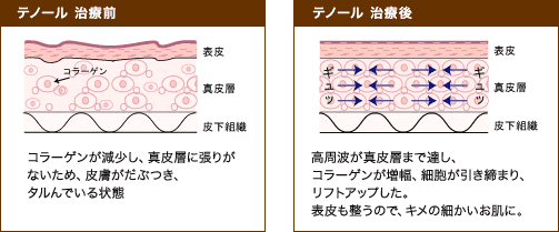 テノールの前後効果図解