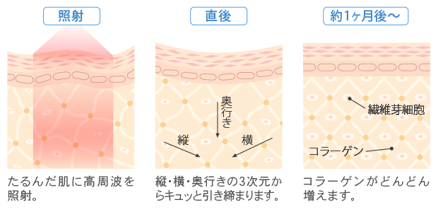 サーマクールCPTの図解