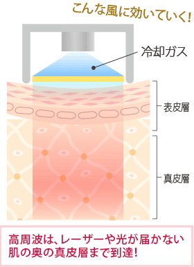 サーマクールCPTの図解