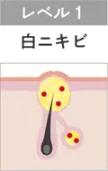 白ニキビ
