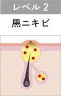 黒ニキビ