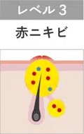 赤ニキビ