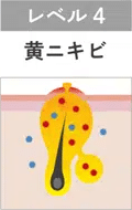 黄ニキビ